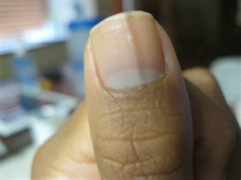 black lines in fingernails